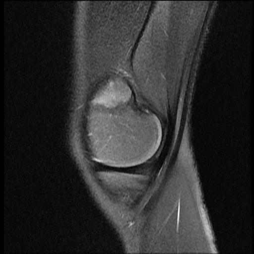 File:Bucket handle tear - lateral meniscus (Radiopaedia 72124-82634 Sagittal PD fat sat 14).jpg