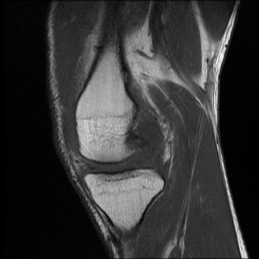 File:Bucket handle tear - medial meniscus (Radiopaedia 69245-79026 Sagittal T1 12).jpg