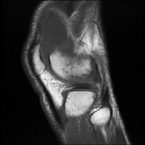 File:Bucket handle tear - medial meniscus (Radiopaedia 69245-79026 Sagittal T1 2).jpg