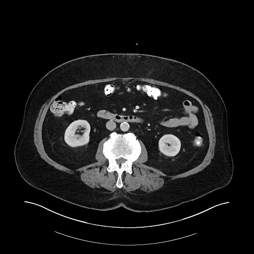 Buried bumper syndrome - gastrostomy tube (Radiopaedia 63843-72575 A 40).jpg