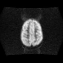 File:Burkitt lymphoma of the orbit- pre and post chemotherapy (Radiopaedia 31214-31930 Axial DWI 14).jpg