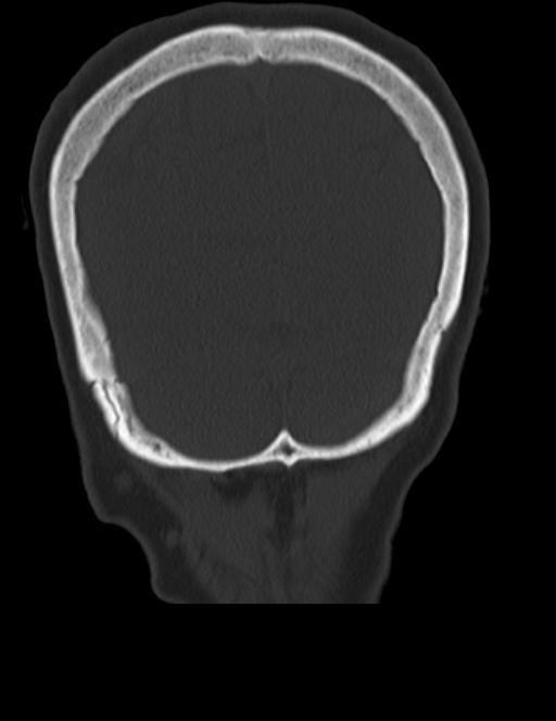 Burnt-out meningioma (Radiopaedia 51557-57337 Coronal bone window 46).jpg
