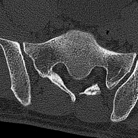 Burst fracture (Radiopaedia 53373-59357 Axial bone window 72).jpg