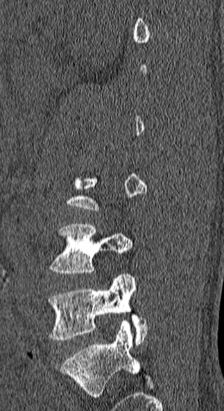 Burst fracture (Radiopaedia 53373-59357 Sagittal bone window 65).jpg