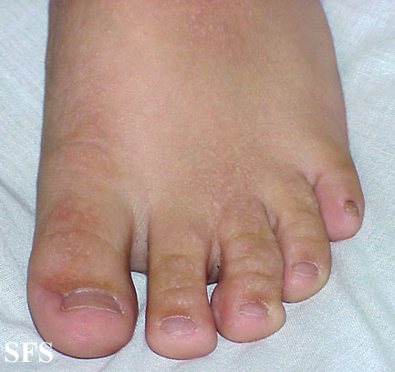 Buschke-Ollendorf Syndrome (Dermatology Atlas 9).jpg