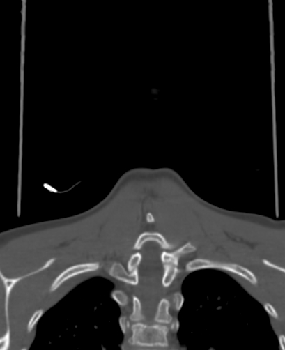 Butterfly vertebra (Radiopaedia 77903-90209 Coronal bone window 84).jpg