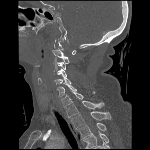 File:C1 anterior arch (plough) fracture - type 1 (Radiopaedia 76181-87720 Sagittal bone window 50).jpg