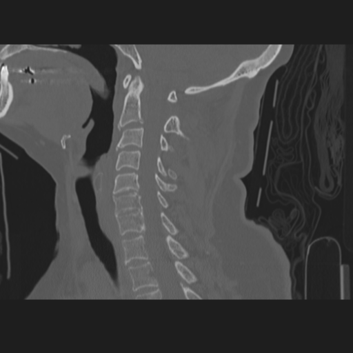 C2 fracture (Radiopaedia 34091-35341 Sagittal bone window 36).png