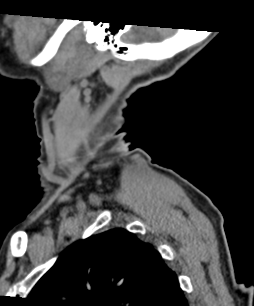 C2 fracture with vertebral artery dissection (Radiopaedia 37378-39199 D 9).png