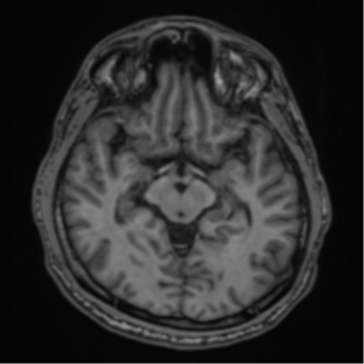 CNS vasculitis (Radiopaedia 55715-62263 Axial T1 16).png