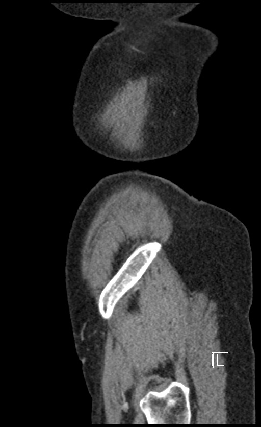 Calcified adrenal glands and Spigelian hernia (Radiopaedia 49741-54988 C 10).jpg