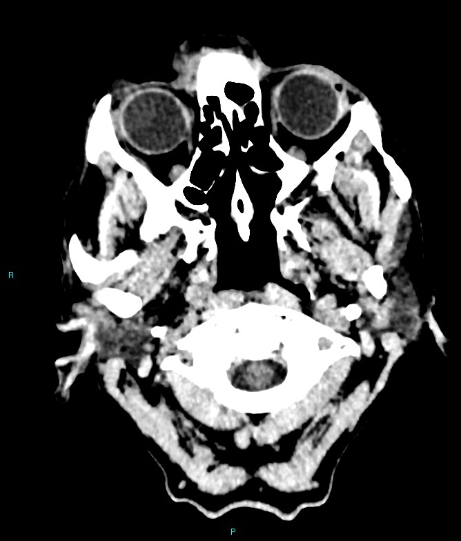 Calcified cerebral emboli from left ventricular thrombus (Radiopaedia 84420-99758 Axial non-contrast 87).jpg