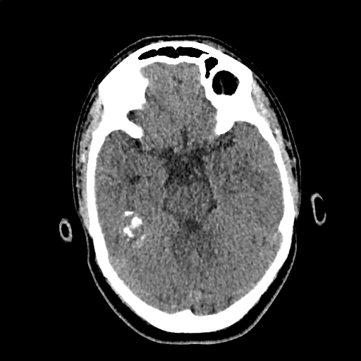 Calcified cerebral hydatid cyst (Radiopaedia 65603-74717 Axial non-contrast 21).jpg