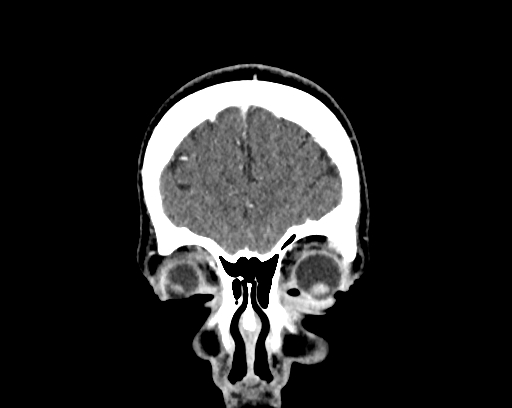 Calcified cerebral hydatid cyst (Radiopaedia 65603-74717 C 5).jpg