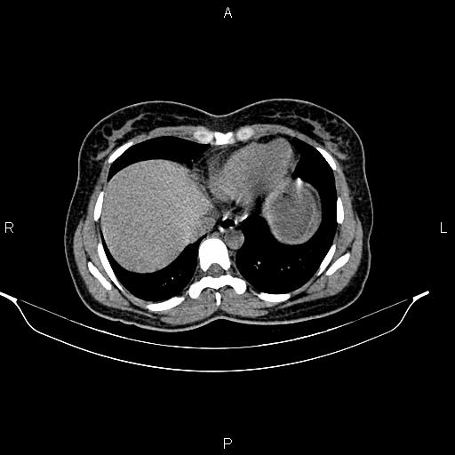 File:Calcified hepatic hydatid cyst (Radiopaedia 84672-100095 Axial non-contrast 13).jpg