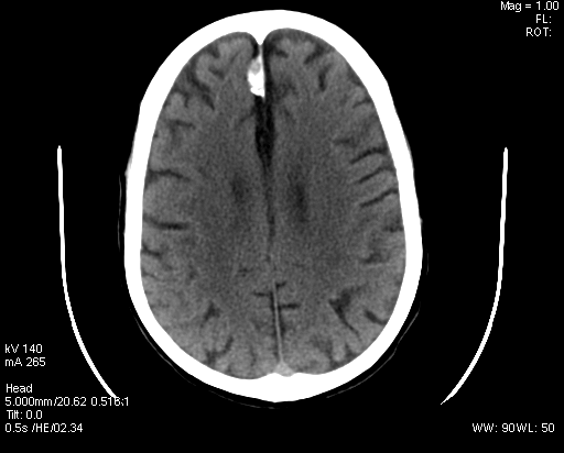 File:Calcified meningioma (Radiopaedia 27515).png