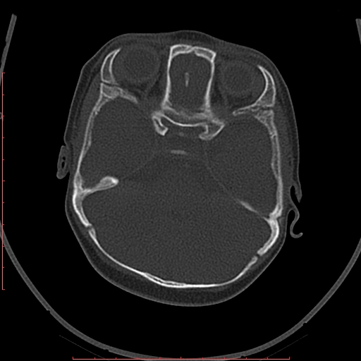 File:Calcified middle cerebral artery embolism (Radiopaedia 78949-91860 Axial bone window 12).jpg