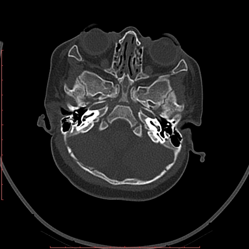 File:Calcified middle cerebral artery embolism (Radiopaedia 78949-91860 Axial bone window 4).jpg