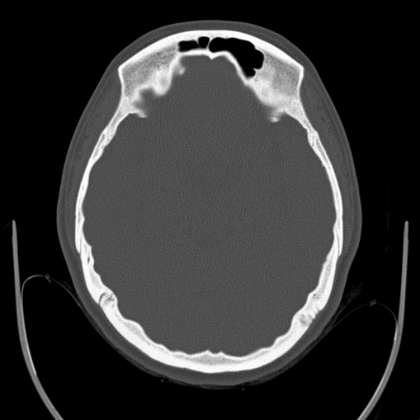 Calvarial osteoma (Radiopaedia 36520-38079 Axial bone window 42).jpg