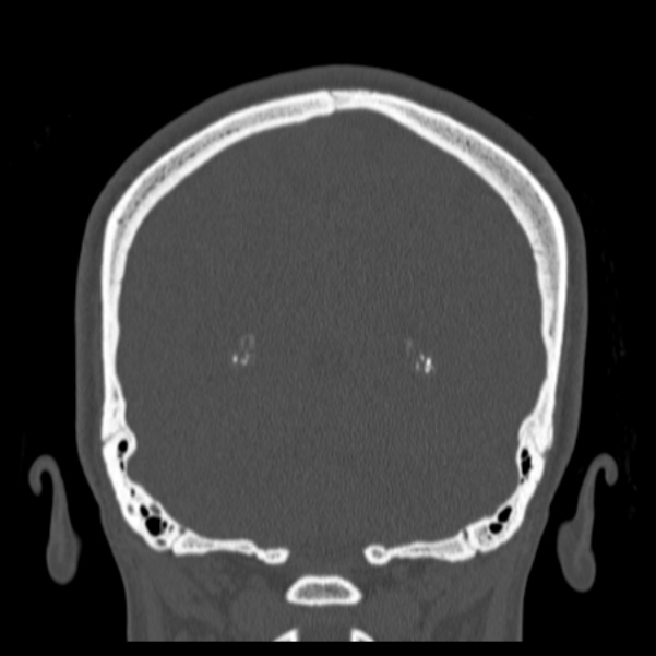 Calvarial osteoma (Radiopaedia 36520-38079 C 69).jpg