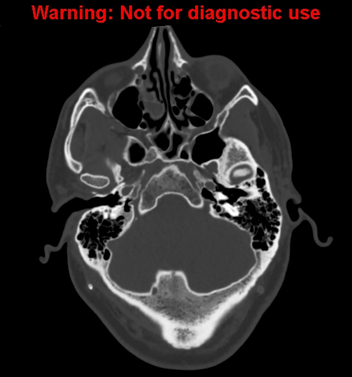 Calvarial thickening from chronic shunting (Radiopaedia 60079-67637 Axial bone window 31).jpg