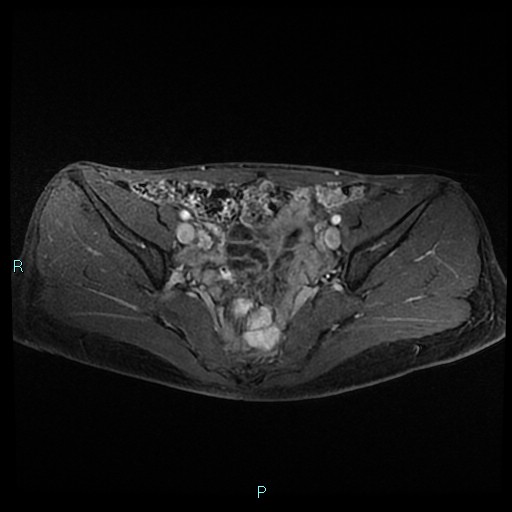 File:Canal of Nuck cyst (Radiopaedia 55074-61448 Axial T1 C+ fat sat 23).jpg