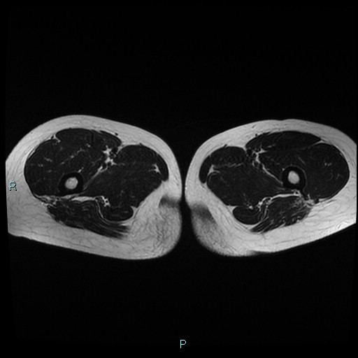 File:Canal of Nuck cyst (Radiopaedia 55074-61448 Axial T2 31).jpg