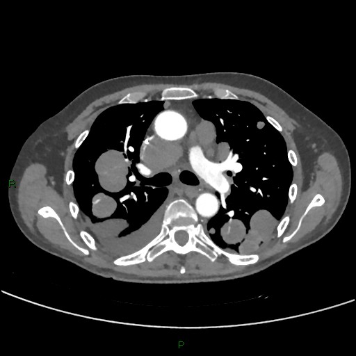 File:Cannonball metastases (Radiopaedia 82110-96150 Axial C+ CTPA 139).jpg