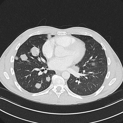 File:Cannonball metastases - testicular choriocarcinoma (Radiopaedia 84510-99891 Axial lung window 57).jpg
