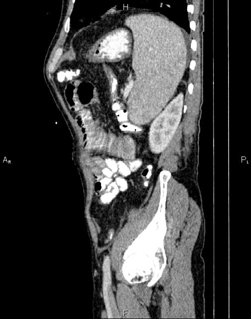 Caput medusae sign - portal hypertension (Radiopaedia 64007-72759 B 68).jpg