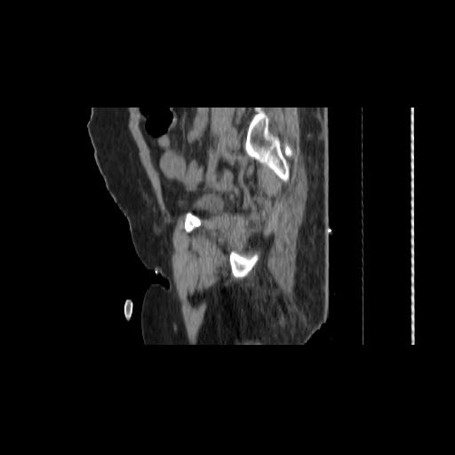 File:Carcinoma cervix- brachytherapy applicator (Radiopaedia 33135-34173 D 138).jpg