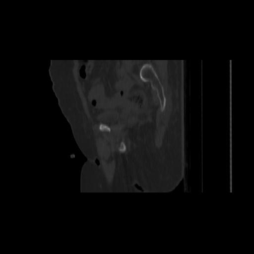 Carcinoma cervix- brachytherapy applicator (Radiopaedia 33135-34173 Sagittal bone window 57).jpg