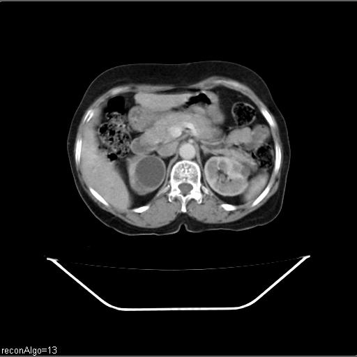 File:Carcinoma cervix- recurrence (Radiopaedia 34702-36137 B 16).jpg