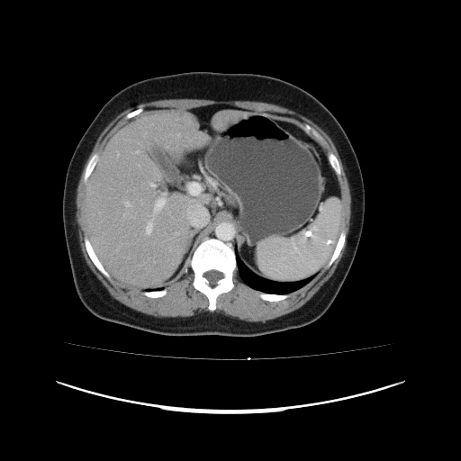 File:Carcinoma colon - hepatic flexure (Radiopaedia 19461-19493 A 34).jpg