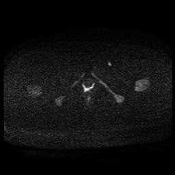 Carcinoma of the cervix (Radiopaedia 89018-105858 Axial DWI 46).jpg