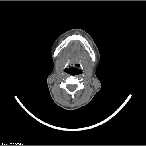 Carcinoma of the maxillary antrum (Radiopaedia 53805-59888 Axial non-contrast 35).jpg