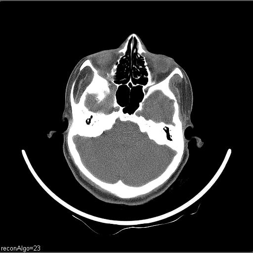 Carcinoma of the maxillary antrum (Radiopaedia 53805-59888 Axial non-contrast 68).jpg