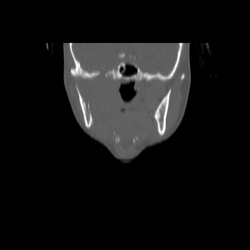 Carcinoma of the maxillary antrum (Radiopaedia 53805-59888 Coronal bone window 69).jpg