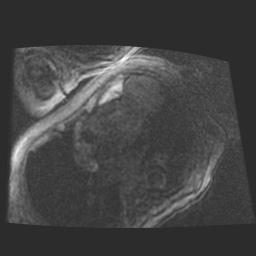 File:Cardiac fibroma (Radiopaedia 38974-41150 4 chamber FGRET 24).jpg