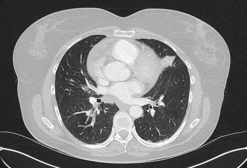File:Cardiac sarcoidosis (Radiopaedia 74548-85534 Axial lung window 45).jpg