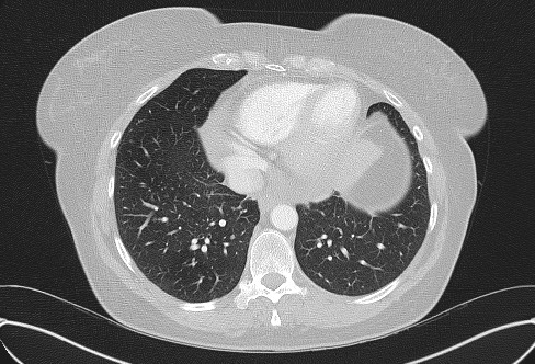 File:Cardiac sarcoidosis (Radiopaedia 74548-85534 Axial lung window 66).jpg