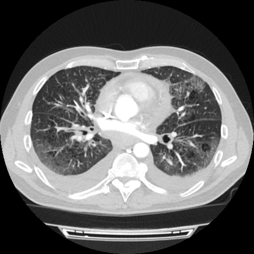 Cardiac tamponade (Radiopaedia 78607-91368 Axial lung window 48).jpg