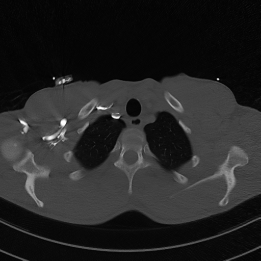 Cardiac tumor - undifferentiated pleomorphic sarcoma (Radiopaedia 45844-50134 Axial bone window 8).png