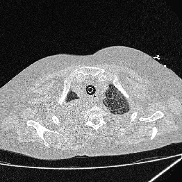 Cardiogenic pulmonary edema (Radiopaedia 29213-29609 Axial lung window 8).jpg