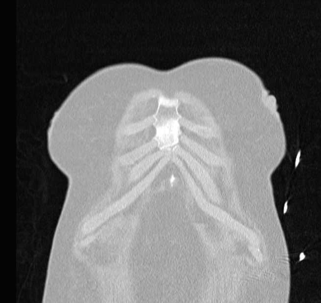 Cardiogenic pulmonary edema (Radiopaedia 29213-29609 Coronal lung window 3).jpg