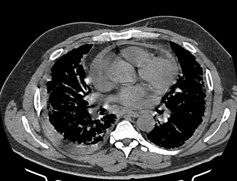 Cardiogenic pulmonary edema (Radiopaedia 68180-77678 Axial non-contrast 27).jpg