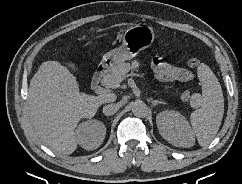 Cardiogenic pulmonary edema (Radiopaedia 68180-77678 Axial non-contrast 68).jpg
