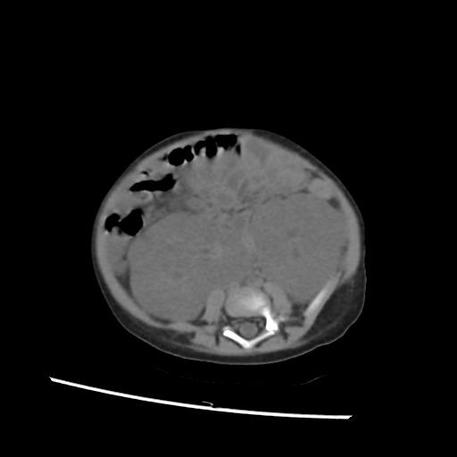 File:Caroli disease with autosomal recessive polycystic kidney disease (ARPKD) (Radiopaedia 89651-106703 Axial non-contrast 39).jpg