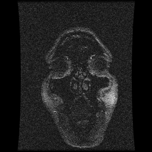Carotid arterial dissection with acute cerebral infarction (Radiopaedia 26636-26784 MRV 145).jpg