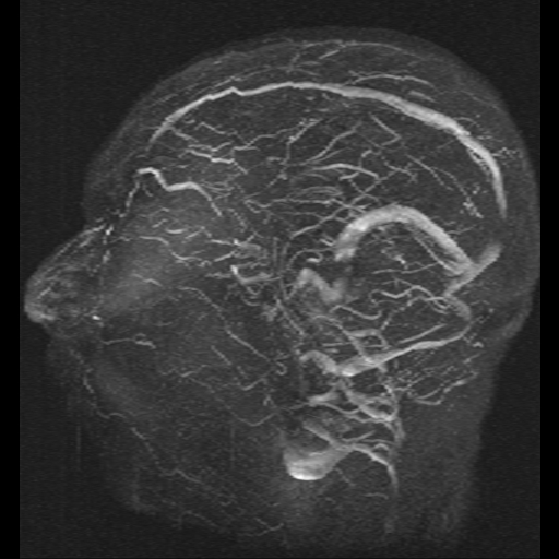 Carotid arterial dissection with acute cerebral infarction (Radiopaedia 26636-26784 MRV 5).jpg